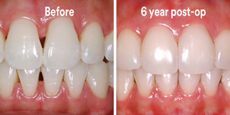 BioClear Diastema Closure and Black Triangle Closure  - Two Rivers Orthodontic Centers, Bolingbrook Dentist