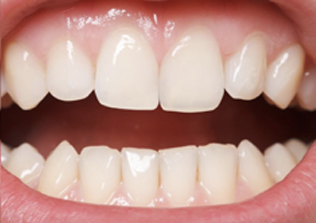 Cosmetic Bonding  - Two Rivers Orthodontic Centers, Bolingbrook Dentist