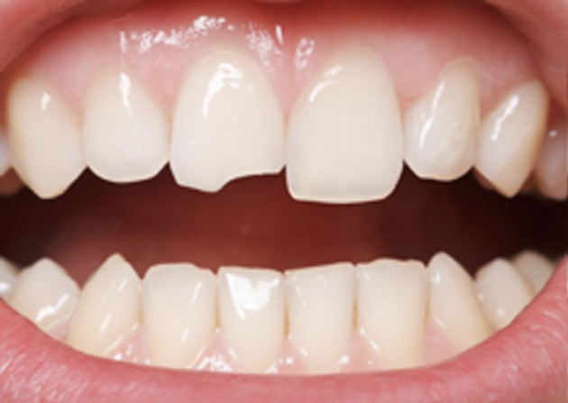 Cosmetic Bonding  - Two Rivers Orthodontic Centers, Bolingbrook Dentist