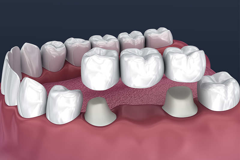 Crowns and Bridges, Inlays and Onlays  - Two Rivers Orthodontic Centers, Bolingbrook Dentist