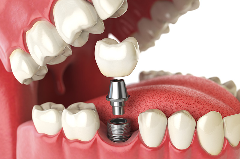 Dental Implants - Two Rivers Orthodontic Centers, Bolingbrook Dentist