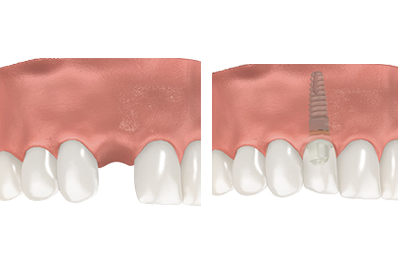 Dental Implants - Two Rivers Orthodontic Centers, Bolingbrook Dentist