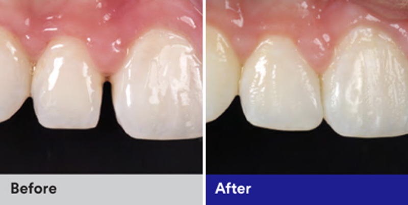 BioClear Diastema Closure and Black Triangle Closure  - Two Rivers Orthodontic Centers, Bolingbrook Dentist