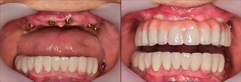 Implant Overdentures and Fixed All-On-X Treatment  - Two Rivers Orthodontic Centers, Bolingbrook Dentist