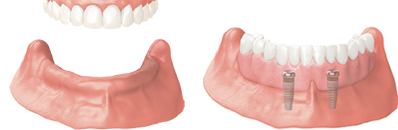 Implant Overdentures and Fixed All-On-X Treatment  - Two Rivers Orthodontic Centers, Bolingbrook Dentist