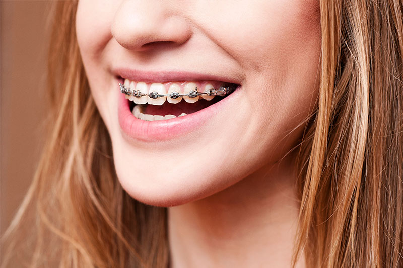 Surgical Orthodontics - Two Rivers Orthodontic Centers, Bolingbrook Dentist