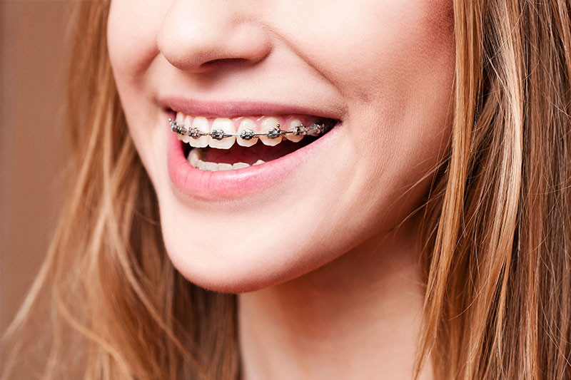 Orthodontics - Two Rivers Orthodontic Centers, Bolingbrook Dentist