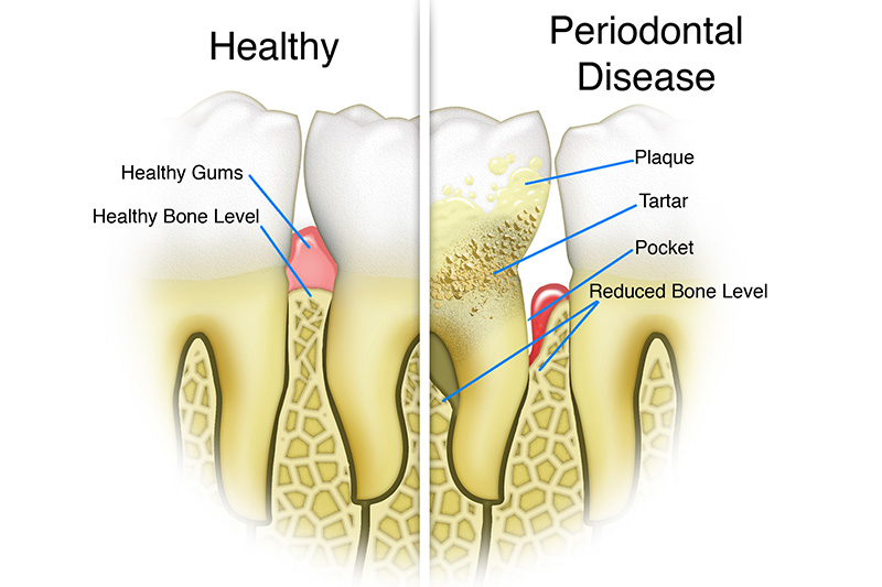 Scaling & Root Planings (Deep Cleanings)  - Two Rivers Orthodontic Centers, Bolingbrook Dentist