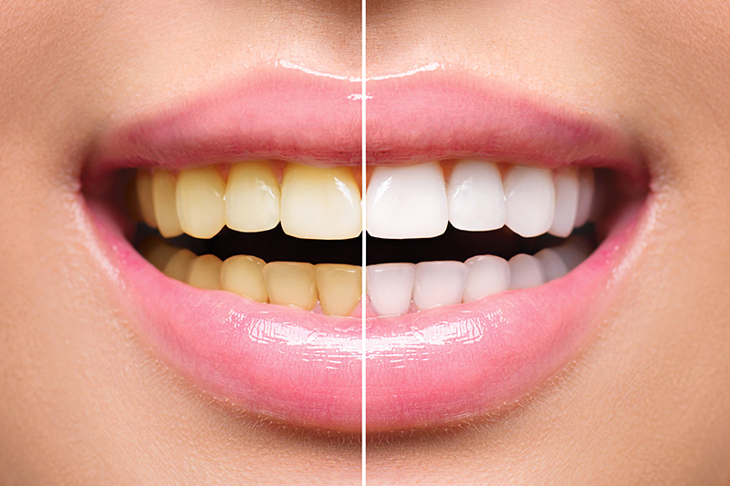 Teeth Whitening - Two Rivers Orthodontic Centers, Bolingbrook Dentist