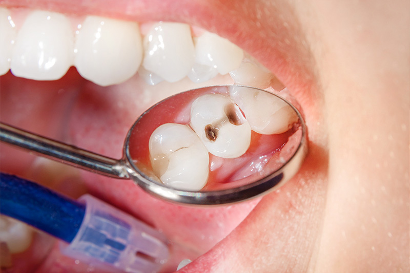 Tooth Colored Composite Fillings  - Two Rivers Orthodontic Centers, Bolingbrook Dentist