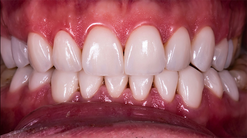 Veneers  - Two Rivers Orthodontic Centers, Bolingbrook Dentist
