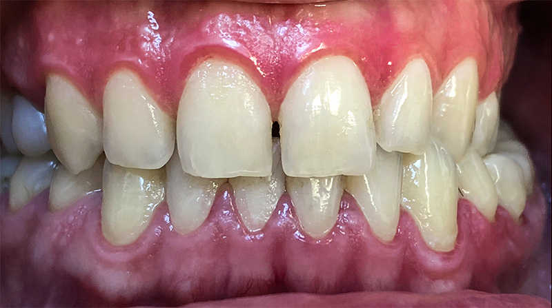 Veneers  - Two Rivers Orthodontic Centers, Bolingbrook Dentist