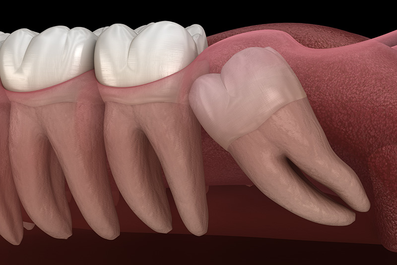 Wisdom Teeth Extractions (with Sedation)  - Two Rivers Orthodontic Centers, Bolingbrook Dentist